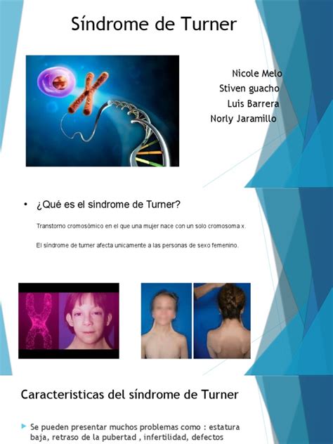 sindrome de turner pdf